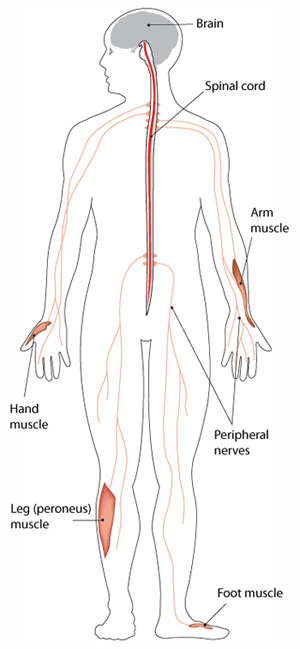 body_CMT